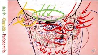 Periodontitis Cure by Bonner Method microscope caricature and drawing. Gum disease