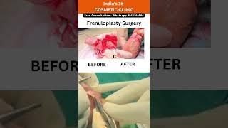 Gentle Frenuloplasty Expert Care for Lasting ComfortPrecision #hospital shorts #Frenuloplasty