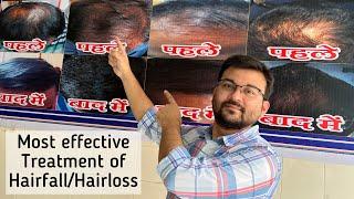 गंजेपन का सबसे ज़बरदस्त इलाज़। Most effective treatment for hairfall/hairloss. Dr Animesh MS