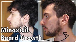 Minoxidil Beard Growth: Three Months