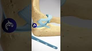 See how an Elbow (Olecranon) Fracture is Repaired - 3D Animation