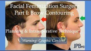 Facial Feminization Surgery Part I: Brow Contouring Planning and Intraoperative Technique