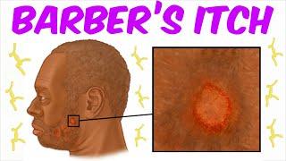 Barber's Itch! (- A Tinea barbae Infection)