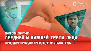 Нитевой лифтинг средней и нижней трети лица