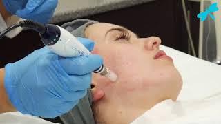 Medical Microneedling The Laser and Skin Clinic