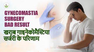 What Happens After Having Bad Gynecomastia Surgery? | खराब गाइनेकोमैस्टिया सर्जरी के परिणाम