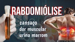 CANSAÇO EXCESSIVO, DOR MUSCULAR E URINA MARROM? PODE SER RABDOMIÓLISE