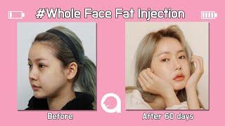 Full Face Fat Transfer at ATOP Plastic Surgery Korea!