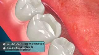 Tooth Restoration Procedures - Inlay