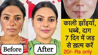 झाइयों से छुटकारा पाये सिर्फ़ 7 दिनों में ॥ Reduce Melasma, Pigmentation, Discolouration, Blackspots