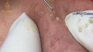 Best blackhead extraction on the face // Loan Nguyen // December #12