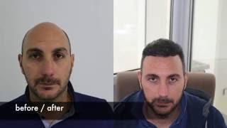 Hair transplant before after, FUE Hair transplant