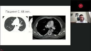 2022_04_28 Клиническая задача сложный пациент с ЛАГ