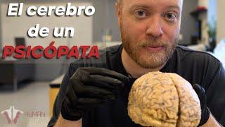 Dentro del CEREBRO de un PSICÓPATA...