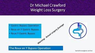 Laparoscopic Gastric Bypass with Dr Michael Crawford