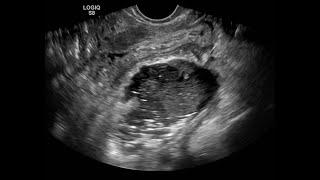 Gynaecological Imaging Part IIIa: Cystic structures outside the ovaries.