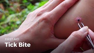 Learn first aid gestures: Tick Bite