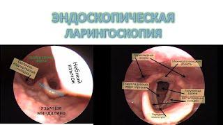 ЭНДОСКОПИЧЕСКАЯ ЛАРИНГОСКОПИЯ НОРМА  лор-хирург к.м.н. Фуки Евгений Михайлович