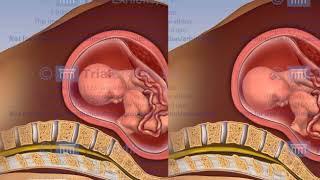 Premature Rupture of the Membranes