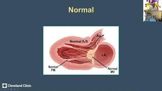 Hypertrophic Cardiomyopathy: Anatomic Variants and Echocardiographic Pearls from Dr Harry Lever