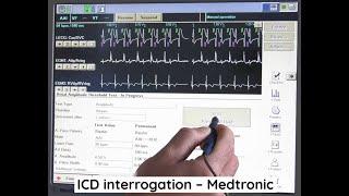 ICD interrogation - Medtronic