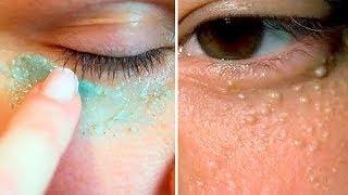 How To Get Rid of Milia at Home - Safe, Easy & Scar Free