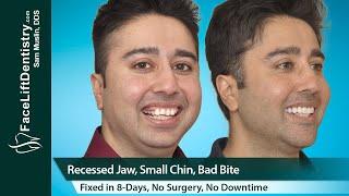 Recessed Jaw, Small Chin, Bad Bite Fixed in 8-Days No Surgery