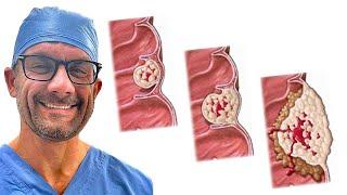Treating Colon Cancer - What You Need to Know!