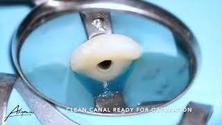 Root canal treatment on the maxillary central incisor (tooth 21)