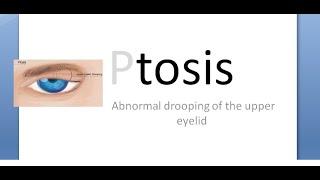 Ophthalmology 388 a Ptosis Congenital Types Classification Definition What is Define Classify