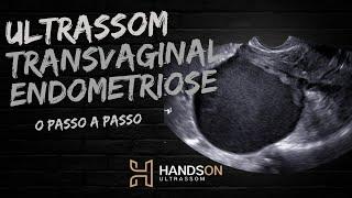 Ultrassonografia Transvaginal com Preparo Intestinal para endometriose / HandsOn Ultrassom