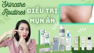 Các bước trị MỤN ẨN dưới da tại nhà - Routines skincare mụn ẩn.| Nguyễn Mai Hương
