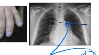 Tuberculosis  Clinical Presentation :: Lab Diagnosis