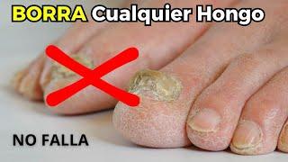 ¡Destruye los Hongos en tus Uñas en Solo 3 DÍAS con Este Poderoso Remedio Casero!