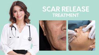 Acne Scar Treatment : Scar Release