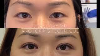 #ChaseLayMD Asian Eyelid Surgery: Anchoring Technique