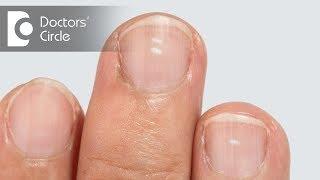 Are white spots on nails caused due to calcium deficiency? - Dr. Aruna Prasad