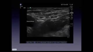 Femoral Neck Fracture - Case Study