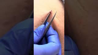 Upper thigh blackhead extraction at Southern Sugaring