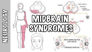 Midbrain Syndromes - Weber’s Syndrome, Benedikt’s Syndrome and Parinaud Syndrome.