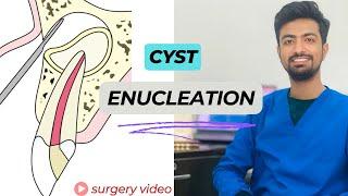 Cyst Removal || Enucleation || Surgical Video || Oral surgery || History of Trauma