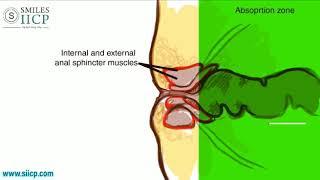 Learn How To Insert Anal Suppository - SMILES Gastroenterology