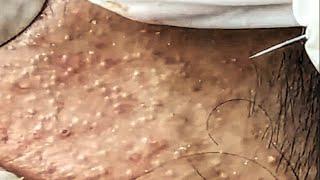 Blackhead Removal With Sac Dep Spa @10006904