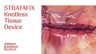 STRATAFIX Spiral PDS Plus Laparoscopic Animation | Ethicon