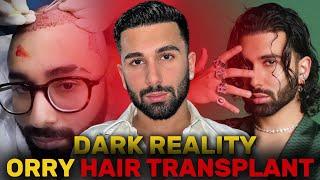 REACT ON ORRY HAIR TRANSPLANT RESULTS | DARK REALITY OF HAIR TRANSPLANT