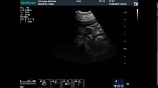 appearance of bowel on ultrasound