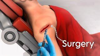 Rotator Cuff Repair ( Laproscopic Method ) Surgery : 3D Animation