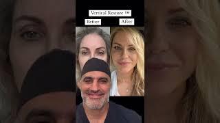 INSANE Facelift Before & After!!! She Looks 25 Years Younger!!!