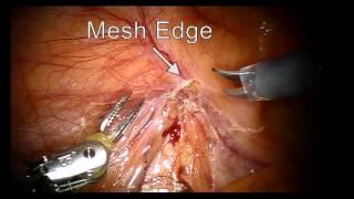 V016 ROBOTIC SPERMATIC CORD LYSIS FOR TREATMENT OF POST-OPERATIVE CHRONIC TESTICULAR PAIN AFTER LAPA