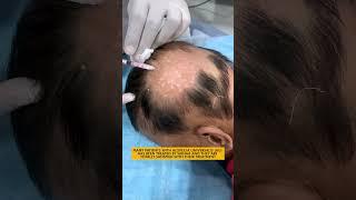 Alopecia Universalis Treatment | Causes, Diagnosis & Hair Re-growth Treatments? |  Skinaa Clinic